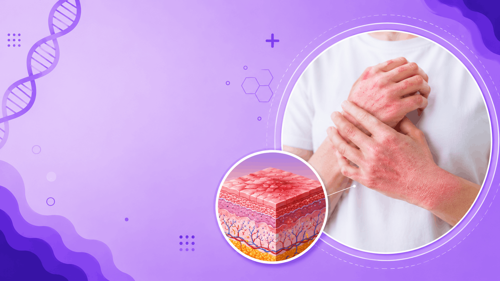 Eczema Banner