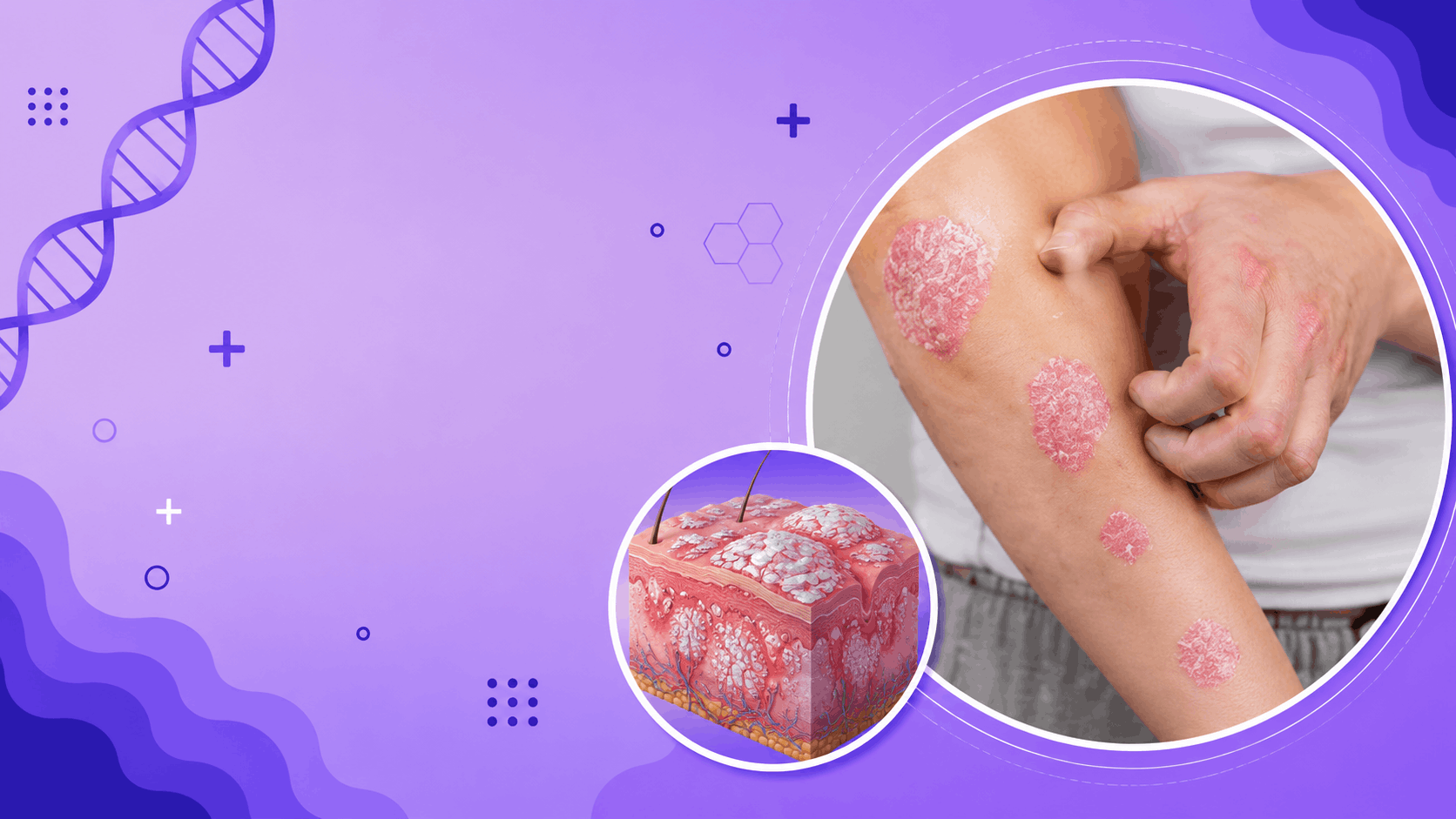 Psoriasis Banner